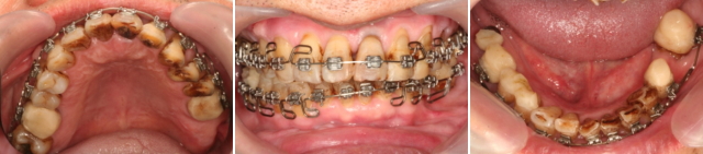 矯正で咬み合わせの治療 矯正で咬み合わせの治療