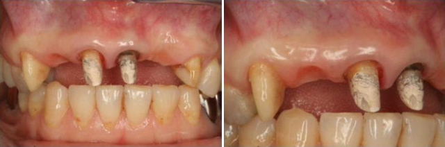虫歯が深く割れていた側切歯は抜歯