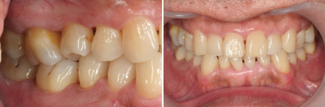 軽度の歯周病 治療後１