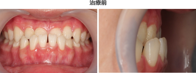 受け口の反対咬合の治療のケース