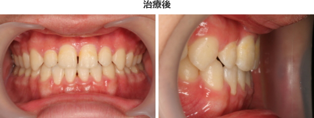 受け口の反対咬合の治療のケース