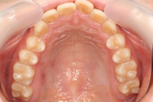 「虫歯なし」(カリセスフリー) 「虫歯なし」(カリセスフリー)