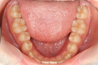 カリエスフリー カリエスフリー