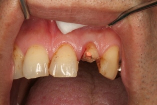 前歯が歯ぐきの部分から割れて来院