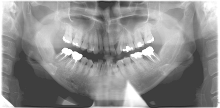 レントゲンでは歯を支えている歯槽骨が吸収を起こしています