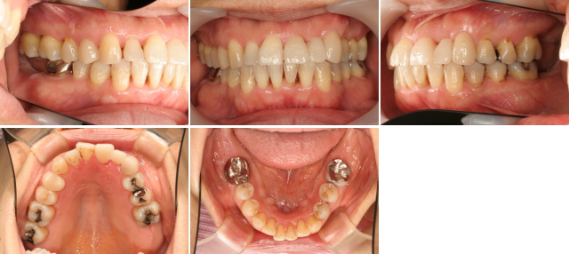 矯正治療期間は１年
