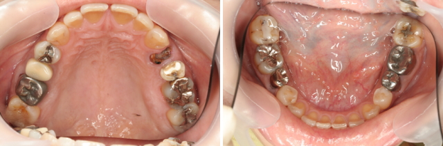 虫歯のリスク評価も行い、総合的に治療