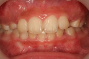 歯の矯正が必要と診断