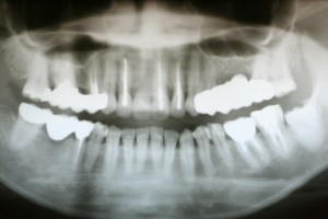 レントゲン写真 レントゲン写真