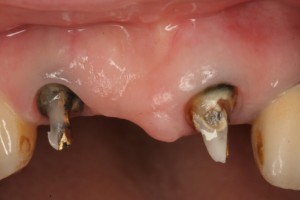 クラウンを外したところ クラウンを外したところ