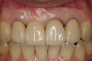 歯肉の手術を行い歯肉のライン、歯の大きさのバランス、色や形態を合わせ完成