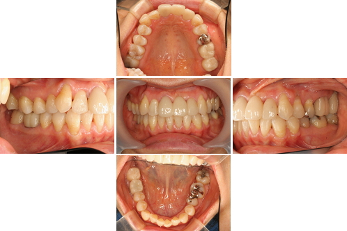 症例２　骨格１級　叢生　歯周病