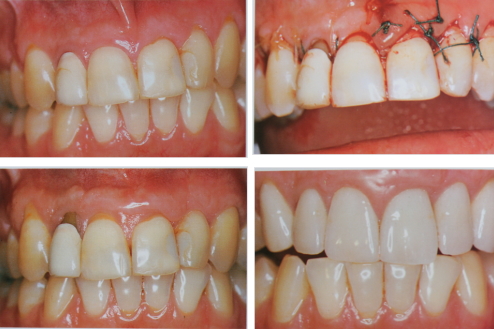 審美の基準を用いて、歯肉の左右の対称性や歯の縦横比を修正