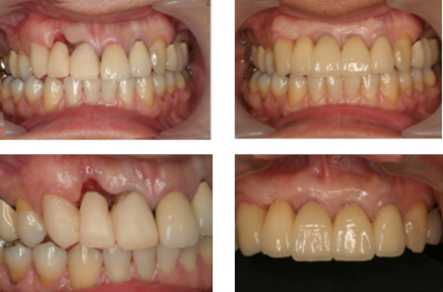 歯肉を失くした患者さん