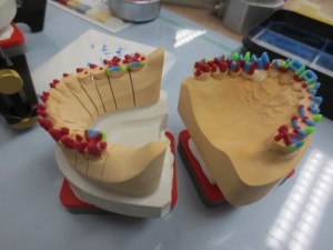 患者さんの歯の製作の途中段階