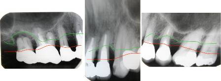 重度の歯周病の場合 術前2