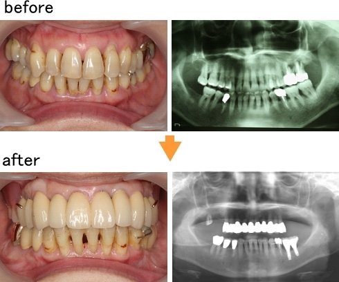 歯周病の積極的な治療をされた56歳女性の治療前と後