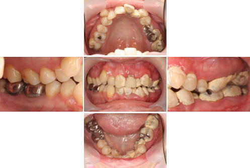 症例２　骨格１級　叢生　歯周病 初診時